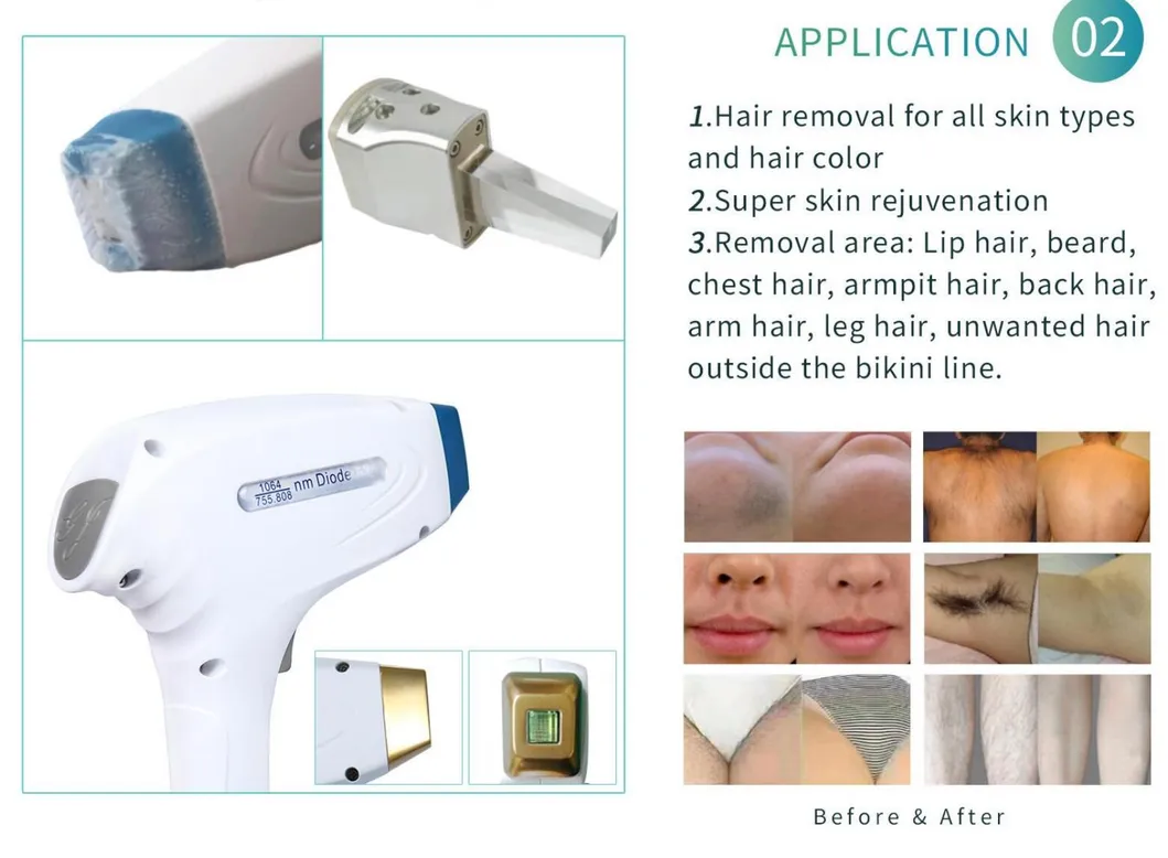 1/6diode Laser 808 Soprano Ice Platinum Triple Wavelength Diodo 755 808 1064 Nm Diode Laser