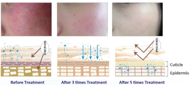 Shumin Star Treatment of Desensitization Control Inflammation