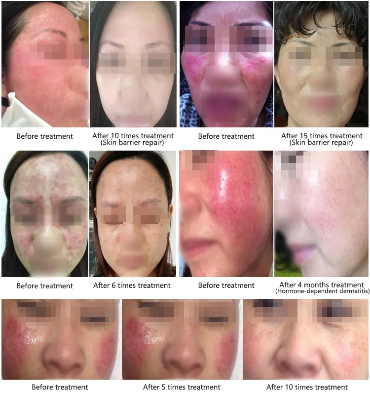 2018 New Eczema Beauty Medical Treatment Machine for Sensitive Skin