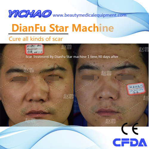 2021 Professional Multifunction Cosmetic Personal SPA Plasma Acne Treatment Machine