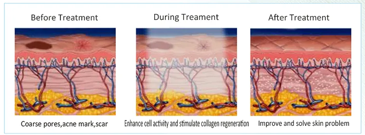 2018 Professional Multifunction Cosmetic Personal SPA Plasma Acne Treatment Machine