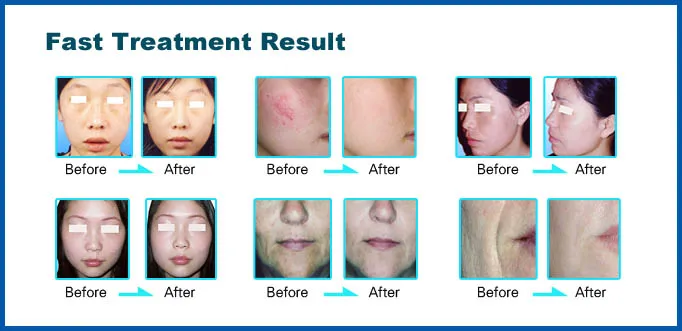 2020 Hot Selling Ce Approved IPL Laser Machine IPL