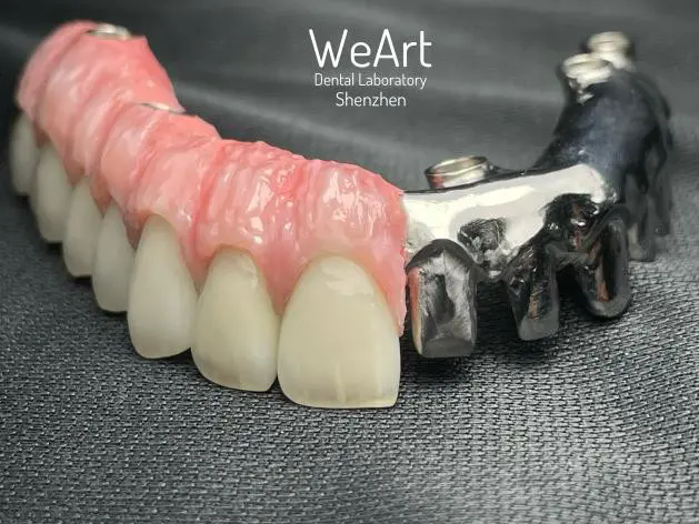What Is Implant Restoration ?