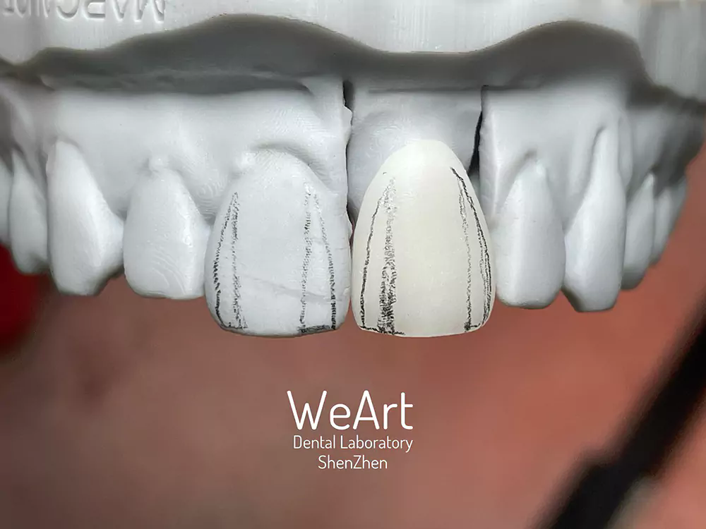 Why Choose IPS e.max Crown for Your Dental Restoration?