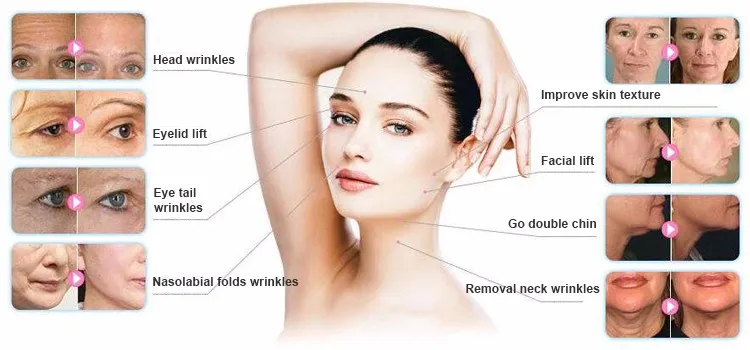 3 in 1 4D Hifu Vmax Liposonic Beauty Device for Salon Use