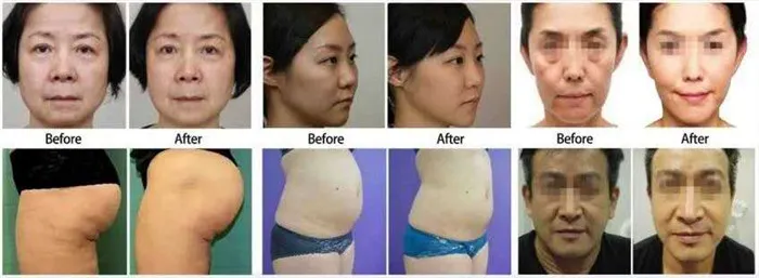 3 in 1 4D Hifu Vmax Liposonic Beauty Device for Salon Use