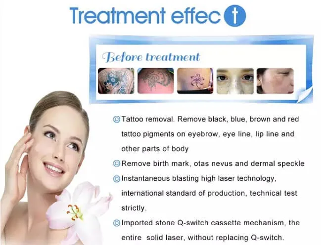 532nm 1064nm 1320nm Pigments Removal Q Switch Tattoo Removal Equipment