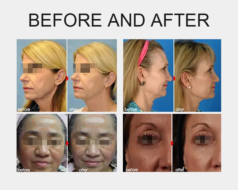 5in 1 4D 5D 9d Hifu Ultra Therapy Vmax Hifu Vaginal Tightening Liposonix Lipohifu Slimming Machine