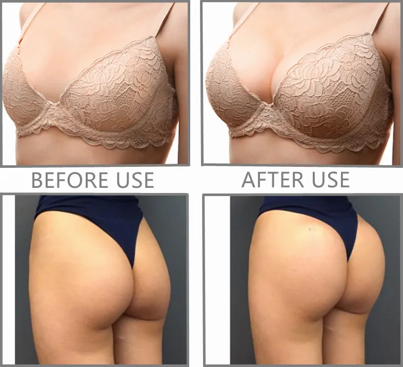 5ml Injectable Breast Increase Dermal Filler Breast Pump Enlargement Hyaluronic Acid Gel