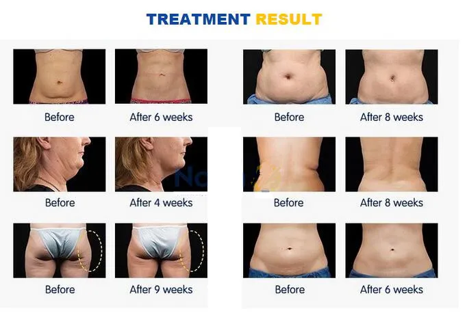 6in1 Ultrasound Cavitation Vacuum RF Lipolaser Weight Loss Machine for Body Slimming