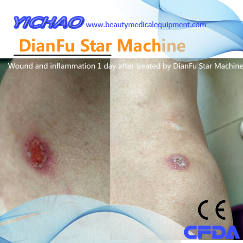 Advances in The Treatment of Keloid by Intradermal Injection