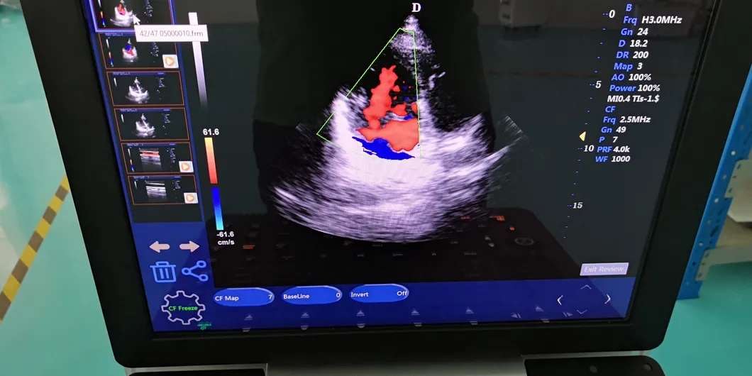 All-Purpose Portable Color Doppler Pft Diagnostic Machine (HP-UC320)