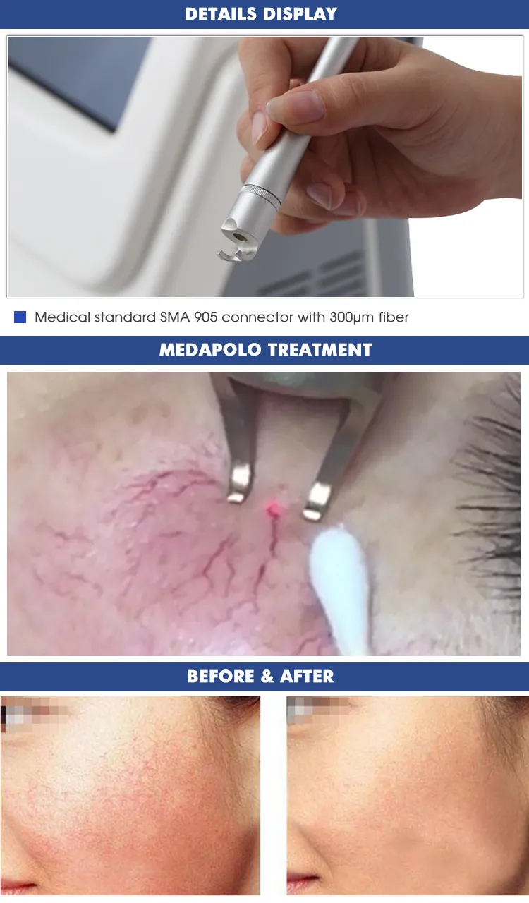 Apolo Vascular Lesions Therapy Leg Veins Treatment 980nm Diode Laser Machine