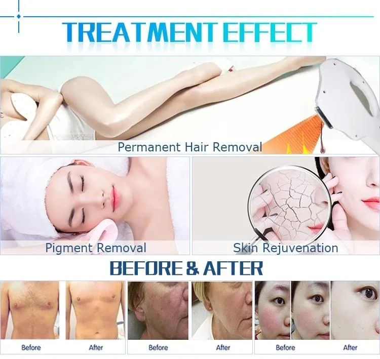 Attractive Photon Multifunctional Depilation Machine Shr IPL 1million Shots
