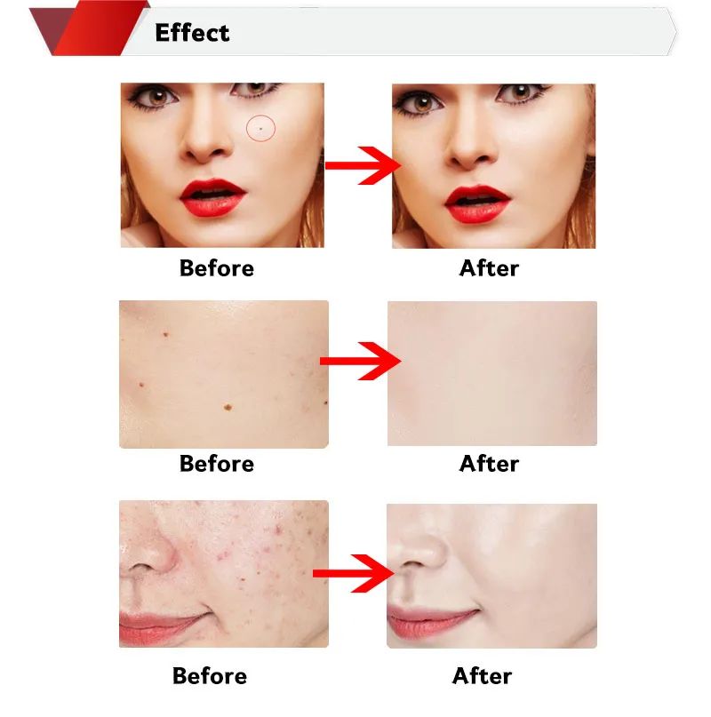 Beauty Laser Spot Freckle Mole Remover Plasma Pen