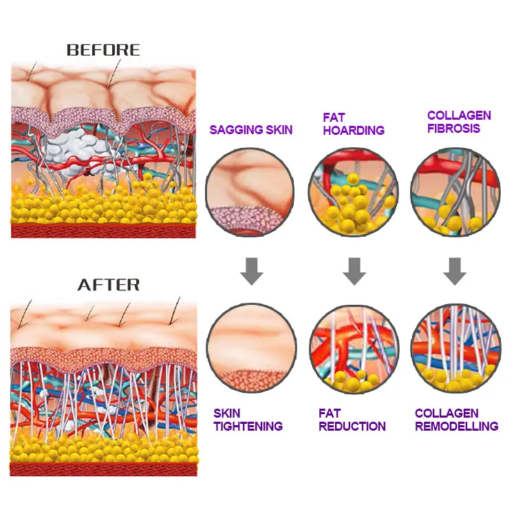 Best Velasmooth V9 Shockwave Slimming Machine in Velasmooth Slimming Machine