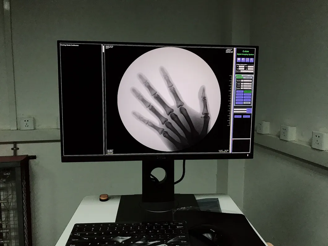 C-Arm X-ray Machine Fluoroscopic Intraoperative Imaging Intensifier