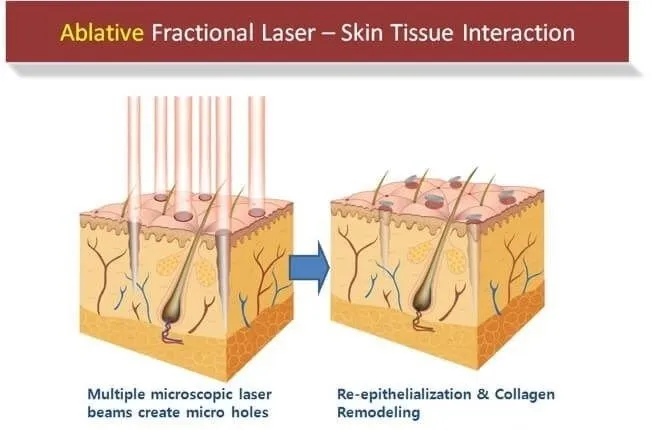 CO2 Fractional Laser with Virginal Treatment Medical Aesthetic Equipment