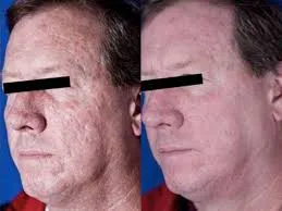 CO2 Fractional Laser with Virginal Treatment Medical Aesthetic Equipment