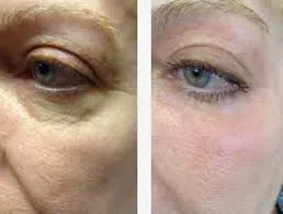 CO2 Fractional Laser with Virginal Treatment Medical Aesthetic Equipment