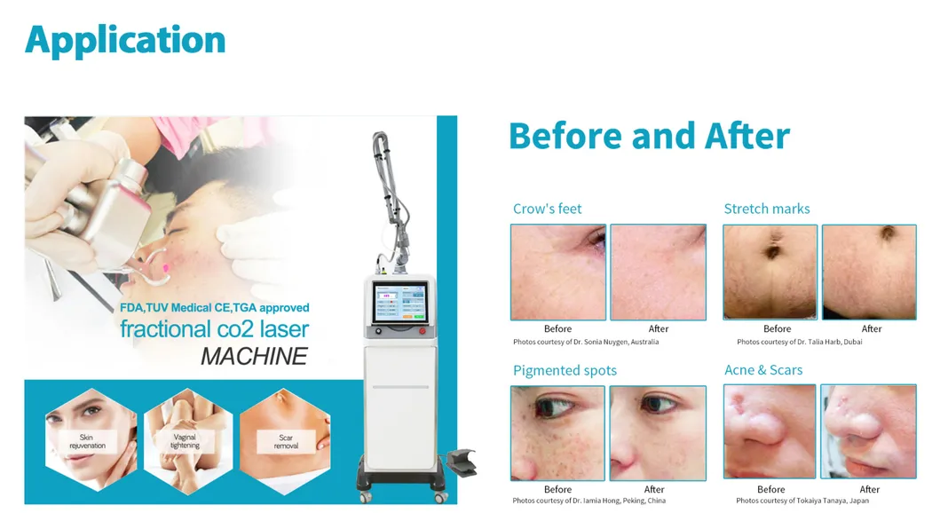 Consultant Be Medical Laser TUV FDA Approved Scar Removal Skin Resurfacing Laser Vaginal Tightening CO2 Fractional