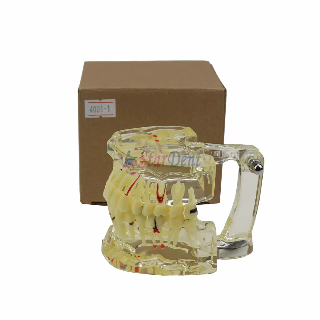 Dental Teeth Model Adult Pathology Typodont Implant Wisdom Tooth Model Ts4001