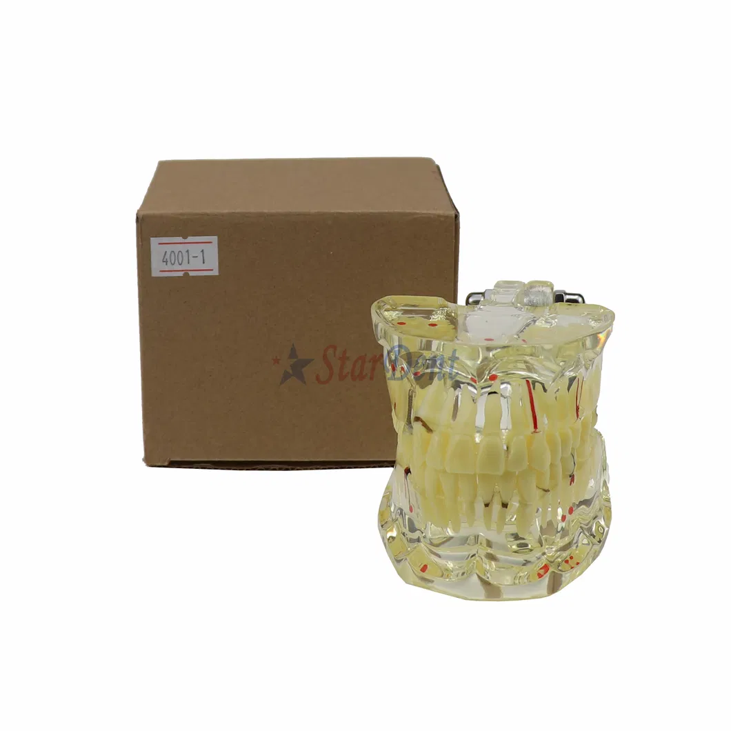 Dental Teeth Model Adult Pathology Typodont Implant Wisdom Tooth Model Ts4001