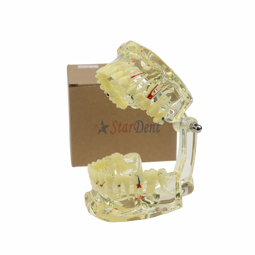 Dental Teeth Model Adult Pathology Typodont Implant Wisdom Tooth Model Ts4001