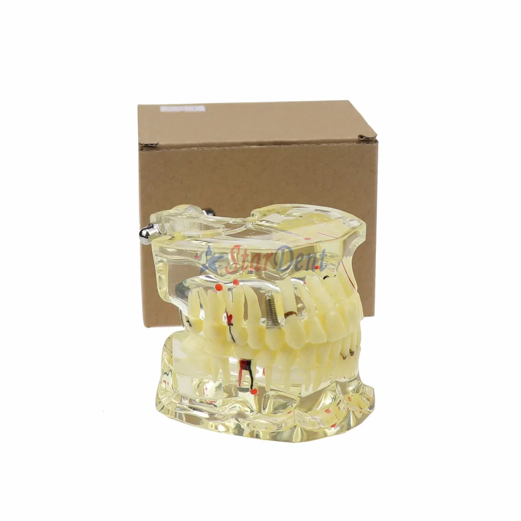 Dental Teeth Model Adult Pathology Typodont Implant Wisdom Tooth Model Ts4001