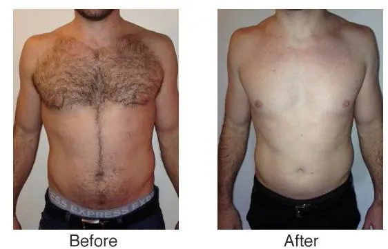 Diode Laser Hair Removal Machine/Alexandrite Laser Hair Removal