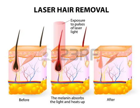 Diode Laser Hair Removal Machine/Alexandrite Laser Hair Removal