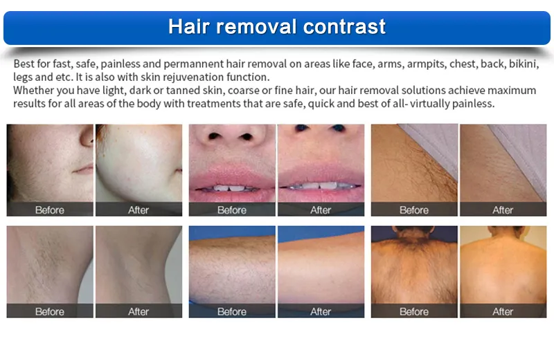 Factory Cheap Price Hair Removal Machine 808nm Diode Laser