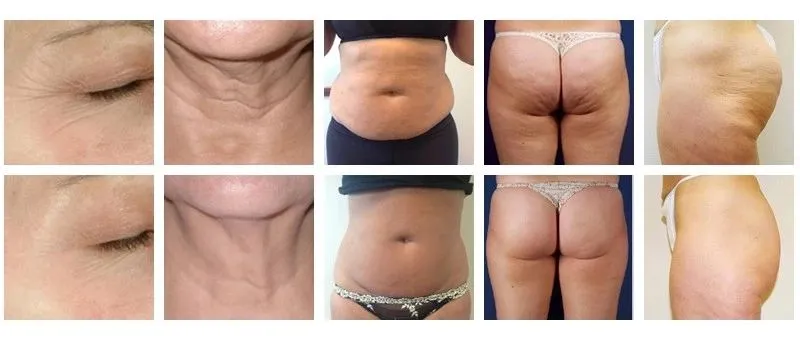Fast Fat Cavitation Slimming System Manual Machine