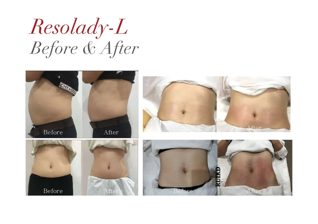 Fat Reduction Ret RF Slimming Machine