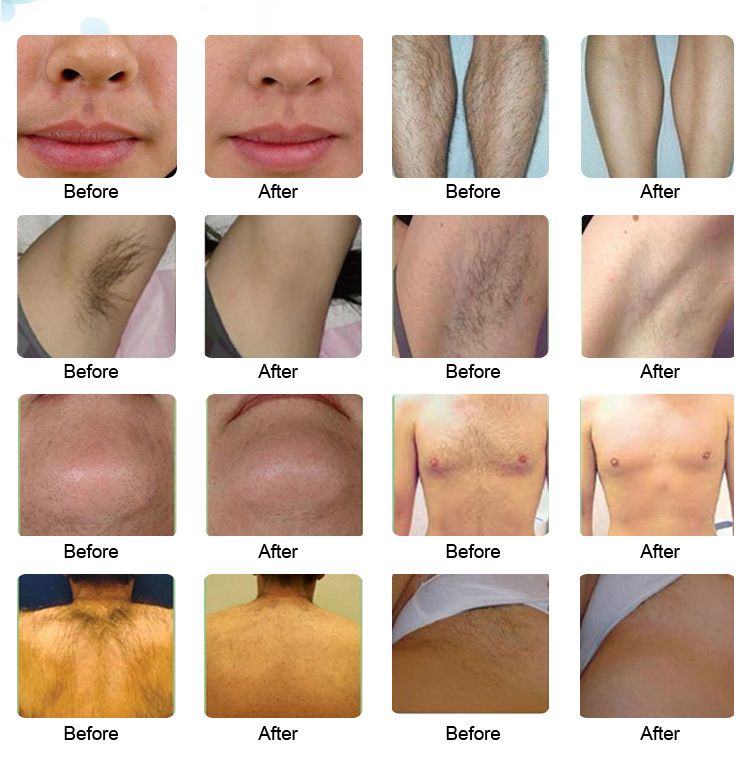 FDA Lumenis Duet Piaget Limelight Laser Hair Removal Diode Laser