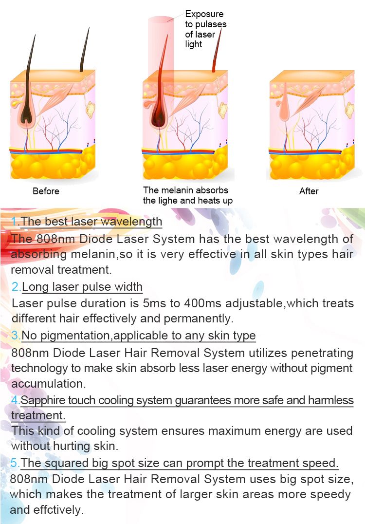 FDA Lumenis Duet Piaget Limelight Laser Hair Removal Diode Laser