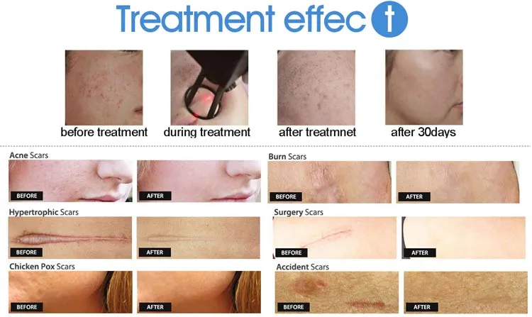 Fractional CO2 Laser 10600nm RF Tube Acne Scars Stretch Marks Removal Vaginal Tightening Medical Equipment