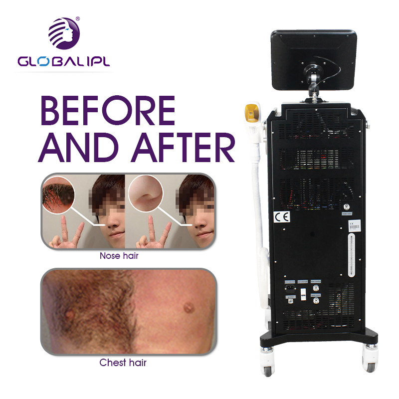 Globalipl Soprano 808nm 4 Waves Diode Ice 200 Million Shots 755+ 1064 +940+808nm Diode Laser Hair Removal Machine Price Ice Platinum Diodenlaser 808