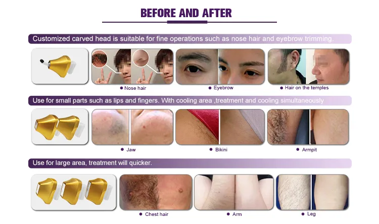 Globalipl Soprano 808nm 4 Waves Diode Ice 200 Million Shots 755+1064+940+808nm Diode Laser Hair Removal Machine Price Ice Platinum Diodenlaser 808