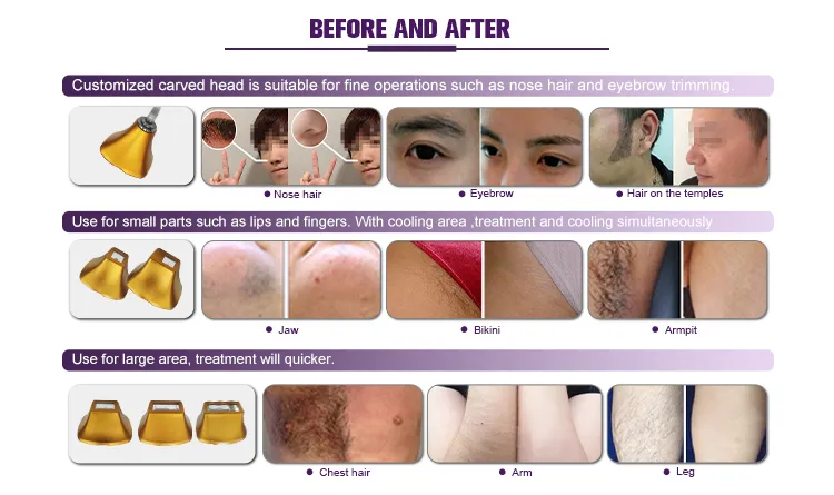 High quality 755nm Diode Laser Permanent Hair Removal Equipment for The Whole Body