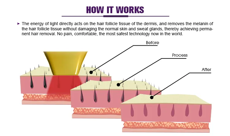 High Quality Painless Permanent Hair Removal 808 Laser Hair Removal Machine Prices for Sale