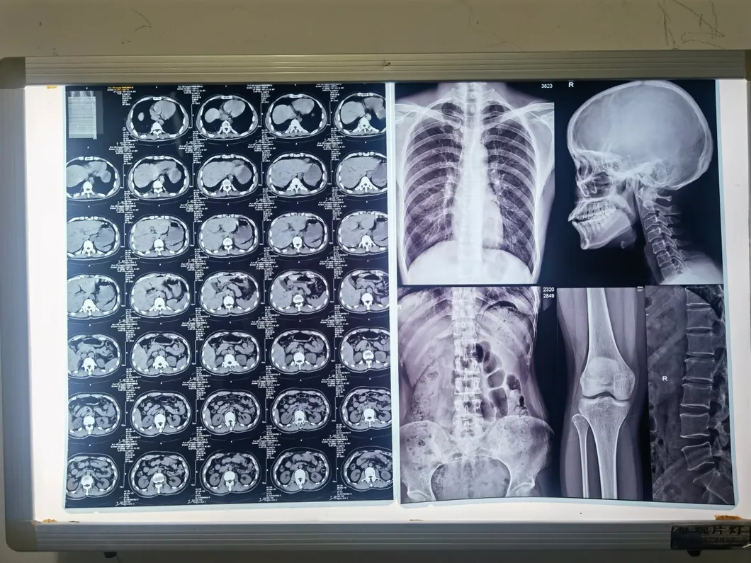 Hospital Use A4 Medical Dry Thermal Sensitive X-ray Film/Pet Imaging Film Low Fog High Quality Polyester Blue Sheet