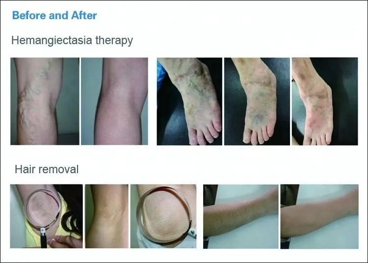 Long Pulse Laser Hair Removal 1064 ND YAG 755 Alexandrite Alex YAG