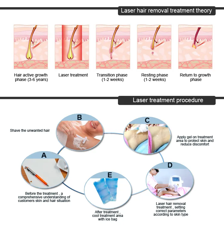 Lumenis Lightsheer Duet Price/Alma Laser Soprano 808nm Hair Removal Machine