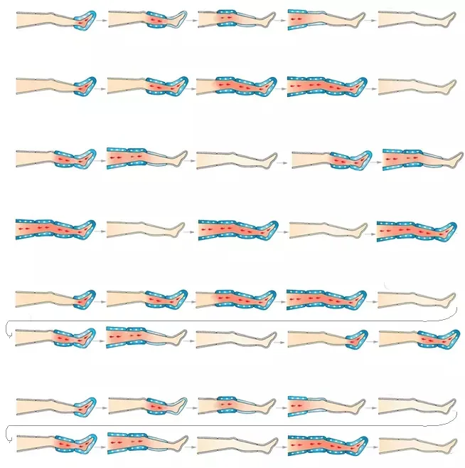 Lymphatic Drainage Massage Blood Circulation System Ipc02 for People Who Has Mild to Severe Varicose Veins