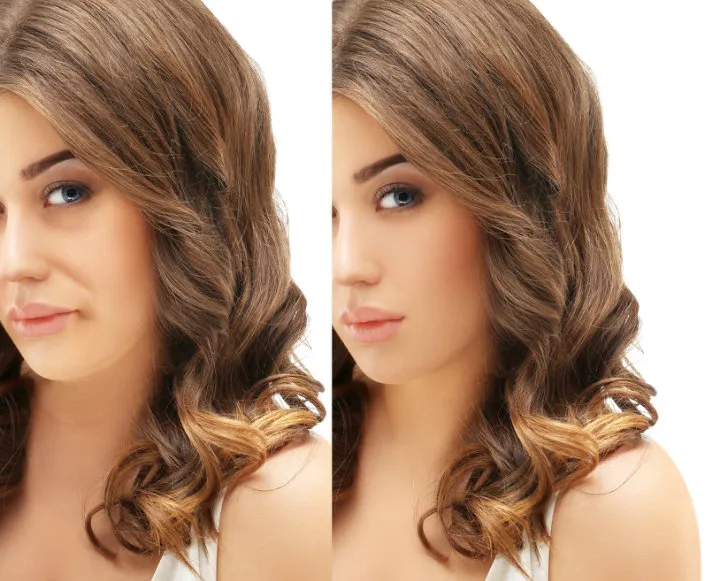 Magicalift Disposable Inject Blunt Needle Cannula