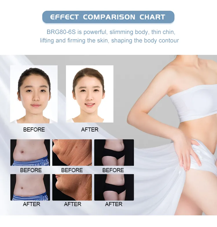 Medical CE Approved Cool Cryo Slimming Machine with 4 Cryo Handles Plus Cavitation and RF