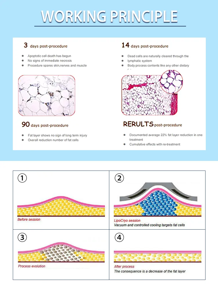 Mini Cryotherapy Vacuum Cryopad Fat Freezing Cryoslim Weight Reduction Body Shaper Fat Reduction Beauty Machine