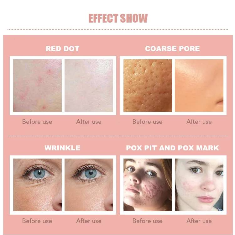 Most Popular Auto Mts Micro Needle Therapy System A6 Dr Pen for Cheecks Skin Rejuvenation Care