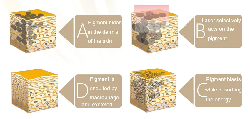 ND YAG Laser Tattoo Removal Carbon Peeling Skin Rejuvenation Beauty Device